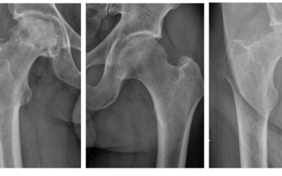 Artrosi dell’Anca, Osteonecrosi e Protesi: Guida Completa alla Salute dell’Anca